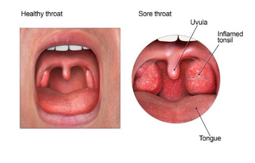 healthy throat vs sore throat